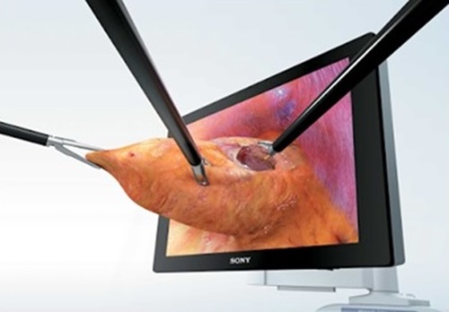 3D Laparoscopic Surgery System