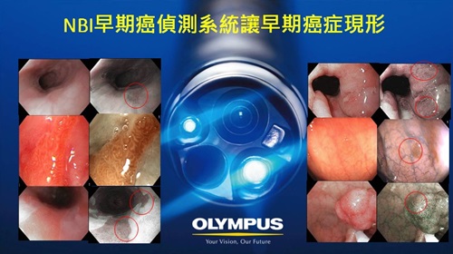NBI早期癌偵測系統